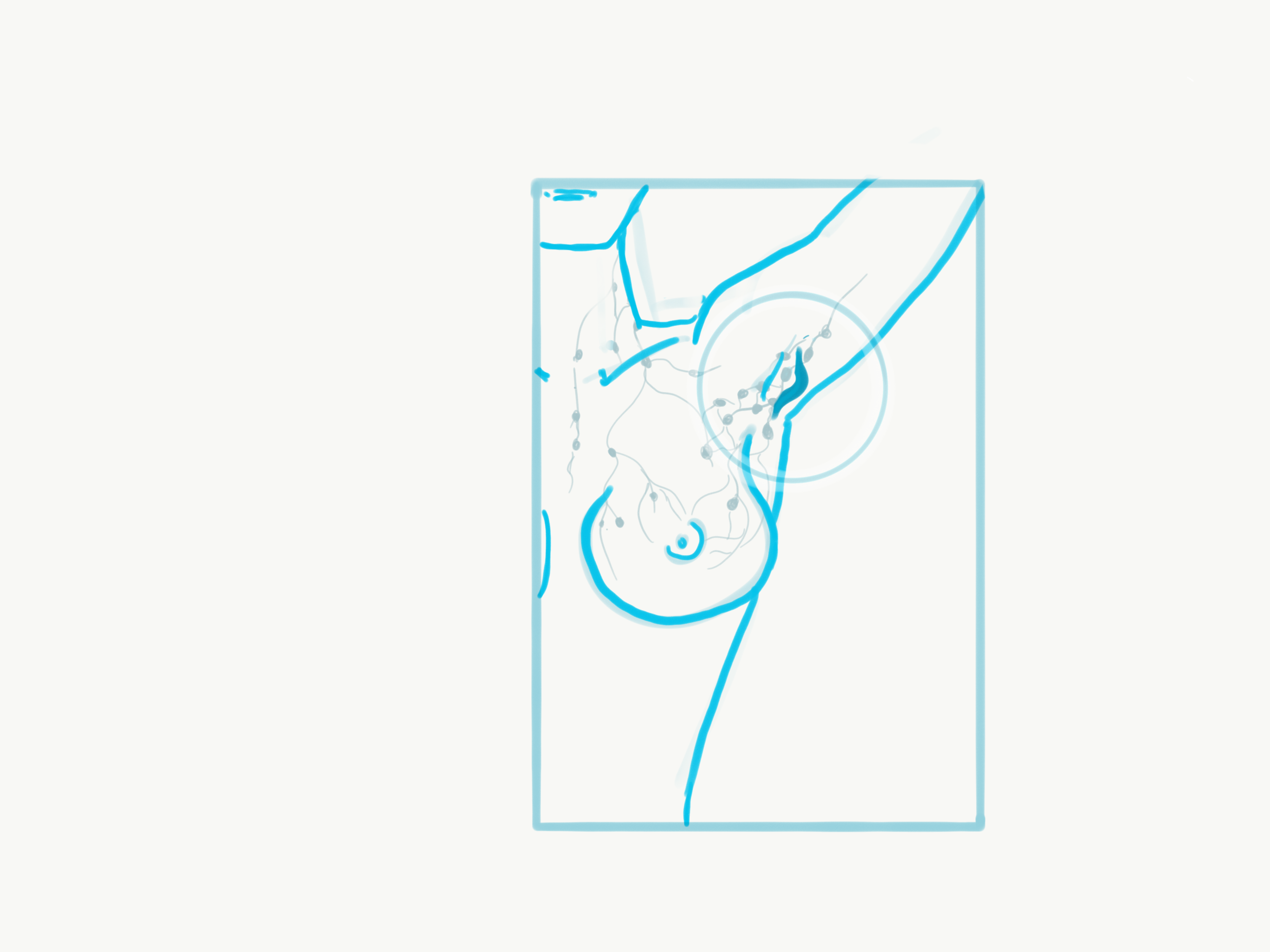 lump in armpit from lymph nodes